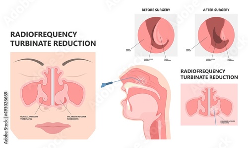 Deviated Ear ENT CPAP nose stop apnea block laser nasal RAVOR RFVTR runny sinus sleep treat airway concha device mucous polyps septal septum throat tissue airflow air way bullosa drip allergic