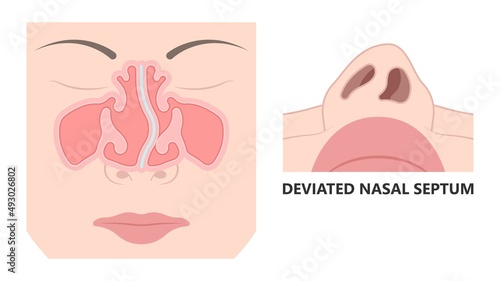 Deviated Ear ENT CPAP nose stop apnea block laser nasal RAVOR RFVTR runny sinus sleep treat airway concha device mucous polyps septal septum throat tissue airflow air way bullosa drip allergic
