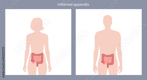 Appendix pain concept