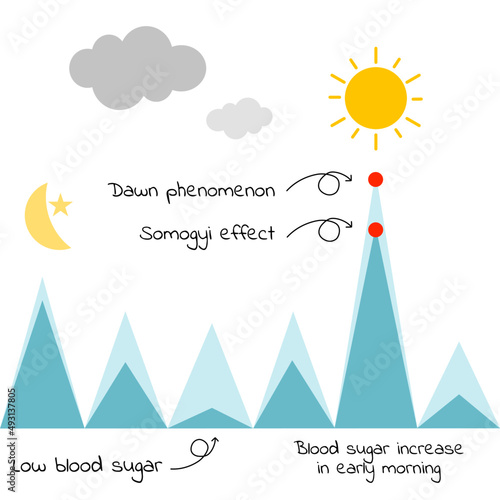 Dawn phenomenon and somogyi effect on early morning in diabetes patient 