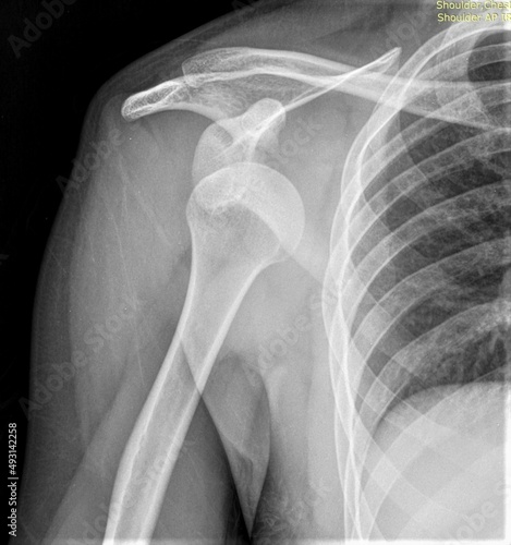 Fotografie right shoulder dislocation,Xray