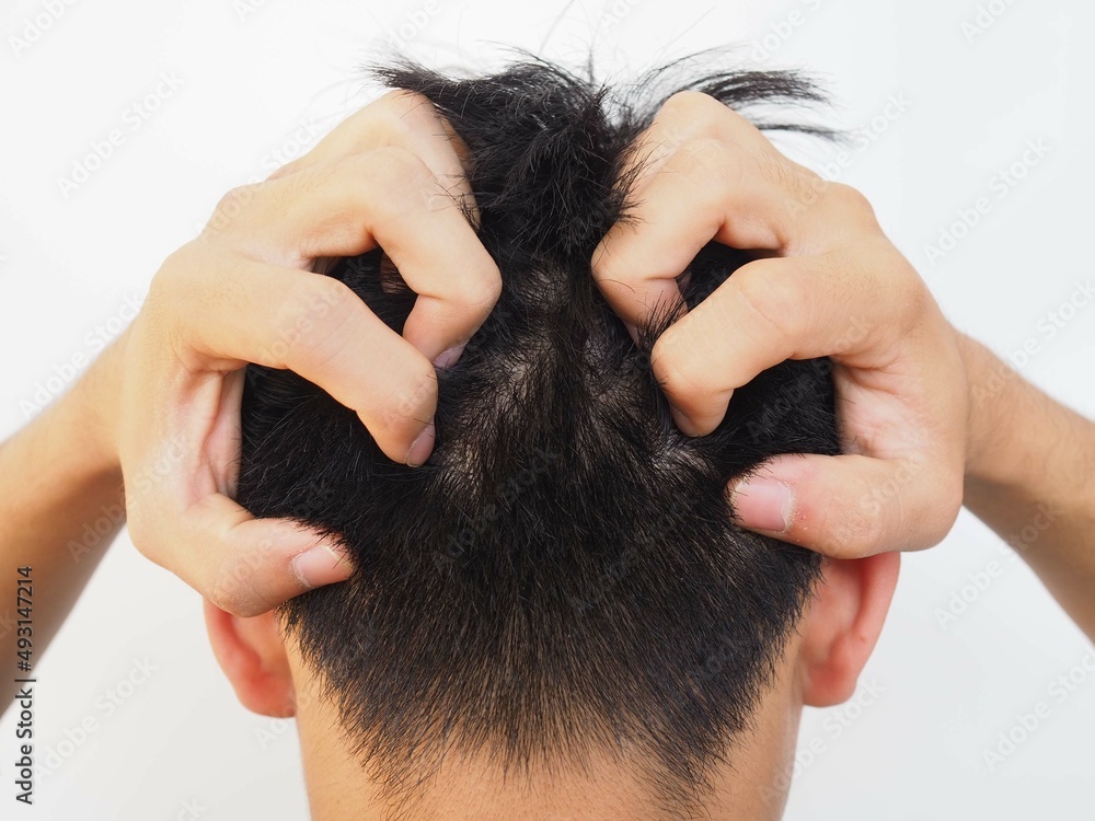 Fototapeta premium Asian man scratching on head from itching. closeup photo, blurred.