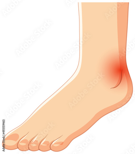 Achilles tendo rupture on white background