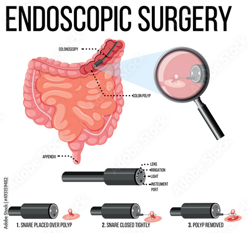 Diagram showing endoscopic surgery