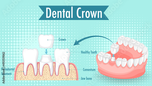 Infographic of human in dental crown