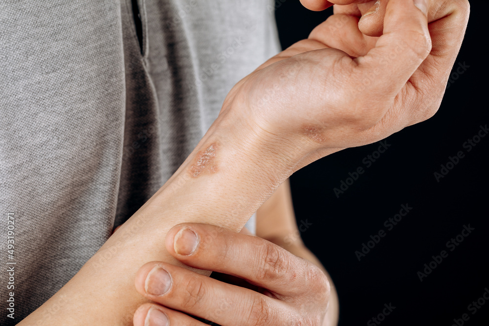 Fototapeta premium Close-up of men's hands with dry skin damage. The concept of dermatology is human hands with skin with cracks and wounds.