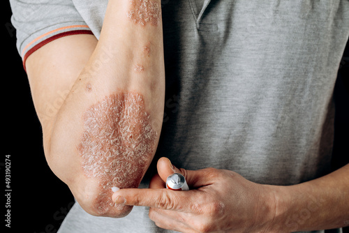 Photography The use of an emollient on dry, flaky skin, as in the treatment of psoriasis, ec