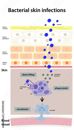 Bacterial skin infection