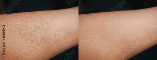 Foto Image before and after leg hairs removal concept.