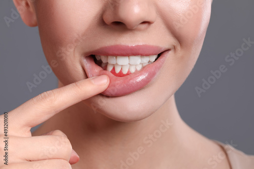 Young woman showing inflamed gums on grey background, closeup