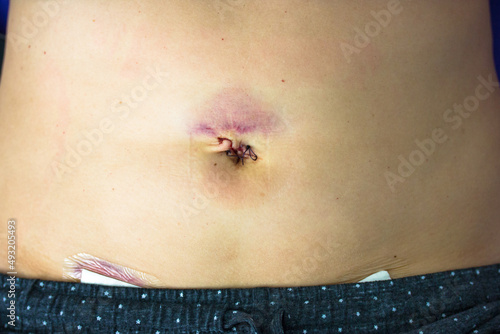 Woman's abdomen fresh medical scars after laparoscopy surgery, remove gallbladder, ovary, uterus, tumor. Wounds on woman's body, abdomen with band-aid. Belly button fresh stitches, hematoma, bruising. photo