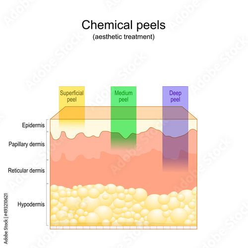 Beauty aesthetic treatment. Chemical peels