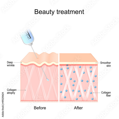 Beauty treatment. Human skin before and after procedure.