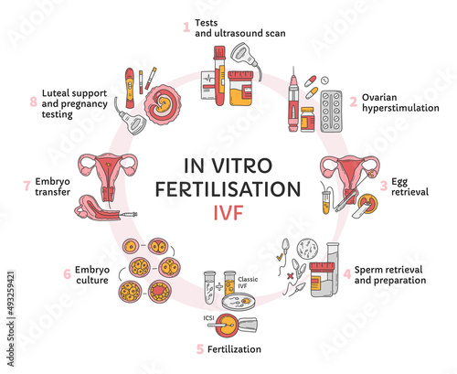 In Vitro fertilization IVF vector circle infographic, infertility treatment scheme. Ovarian hyperstimulation, artificial insemination, embryo culture, luteal support. Medical procedure for pregnancy
