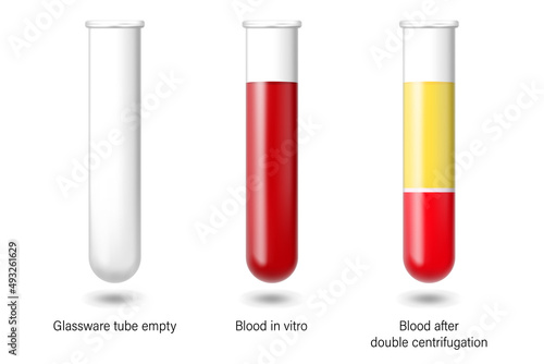 Glassware tube empty, blood in vitro and blood after double centrifugation. Medical laboratory.