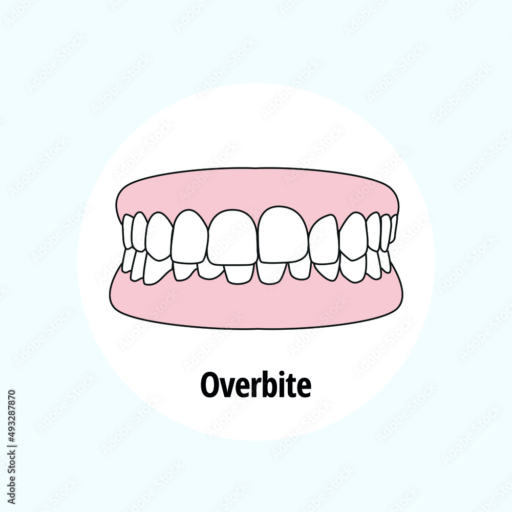 Overbite. Dental problem vector illustration. Dental care concept. Overbite. Dental problem vector illustration. Dental care concept.