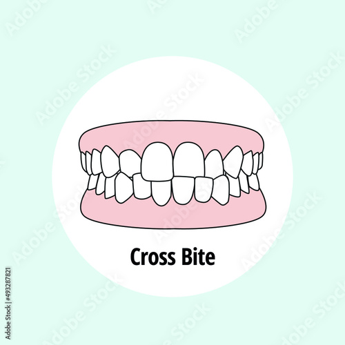 Cross Bite. Dental problem vector illustration. Dental care concept. photo