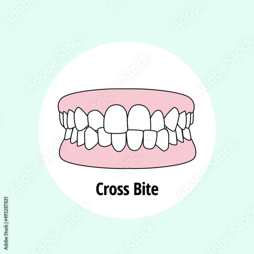 Cross Bite. Dental problem vector illustration. Dental care concept.