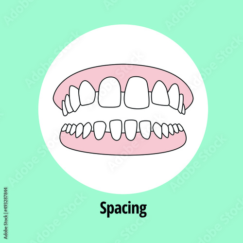Open Bite. Dental problem vector illustration. Dental care concept.