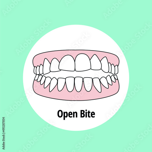 Open Bite. Dental problem vector illustration. Dental care concept.