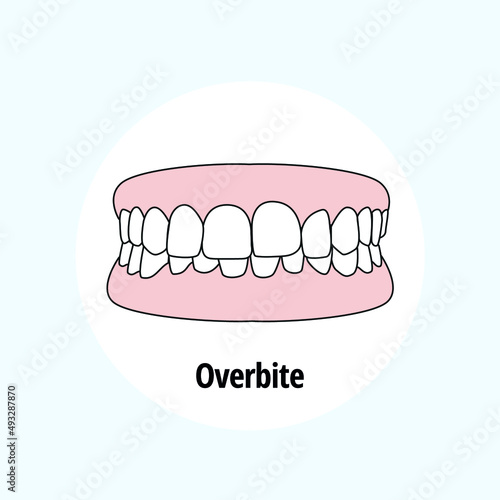 Overbite. Dental problem vector illustration. Dental care concept.