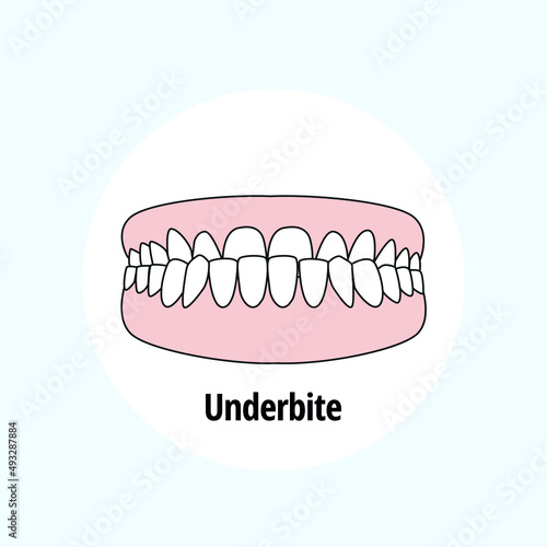 Underbite. Dental problem vector illustration. Dental care concept.
