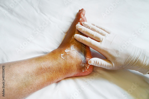 Doctor puts cream on the injured leg.