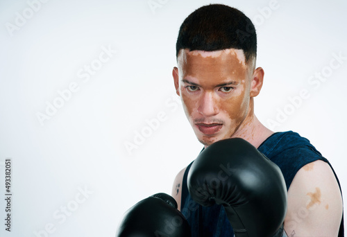 When life gets harder challenge yourself to be stronger. Portrait shot of a handsome young male boxer with vitiligo posing in studio.