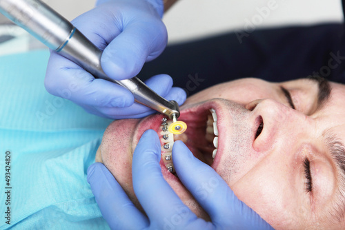 A man installs braces in a dental clinic.Installing braces. Separation in dentistry. Removal of a part of the enamel. Modern dentistry. Photo in a real clinic.