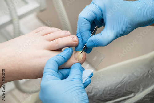 Analysis of the problem nail scraping of the female nail for further diagnosis.