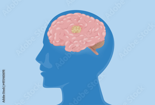 The brain in the silhouette human head has a tumor. medical diagram about Cancer cell metastasis at the human internal organ and nervous system.