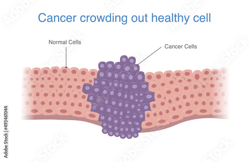 Cancer cells crowd out the healthy cells. medical diagram about Cancer metastasis that will develop to the tumor.