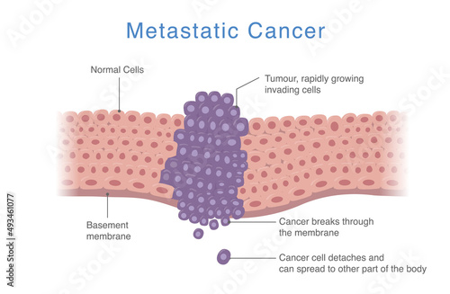 Cancer spreads from one part of the body to other parts. Medical diagram about Process of Metastatic cancer that develops to the tumor.