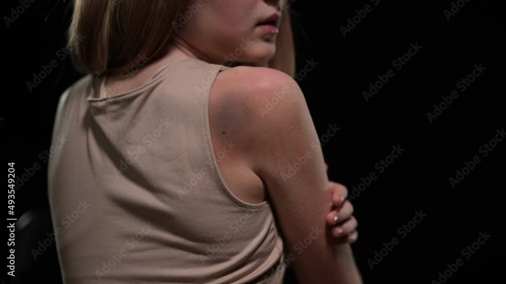 Back view teenage girl showing bruise on shoulder posing at black background. Struck Caucasian teenager with trauma thinking. Kidnapping and violence concept Back view teenage girl showing bruise on shoulder posing at black background. Struck Caucasian teenager with trauma thinking. Kidnapping and violence concept