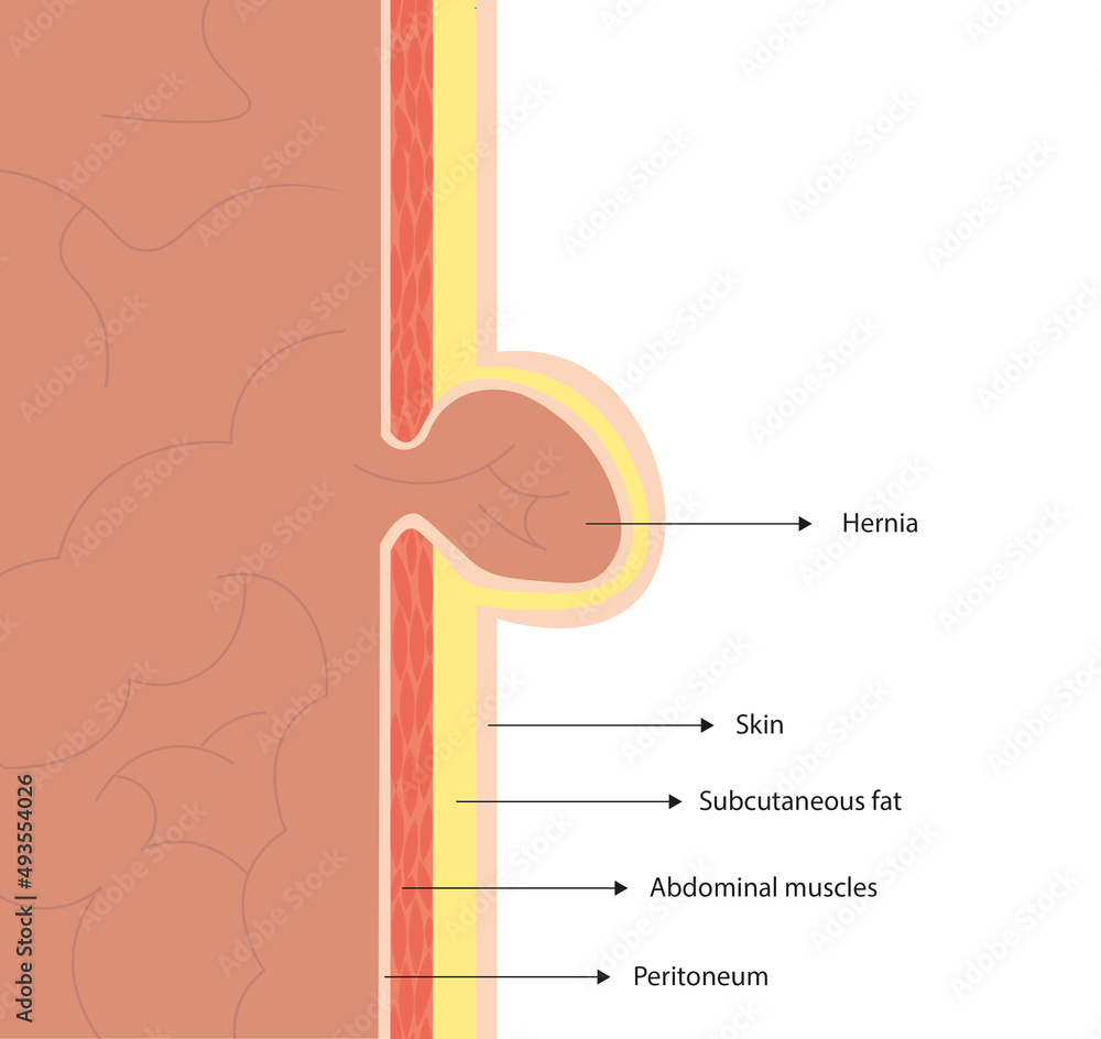 Umbilical hernia. Side view of an umbilical hernia with anatomical