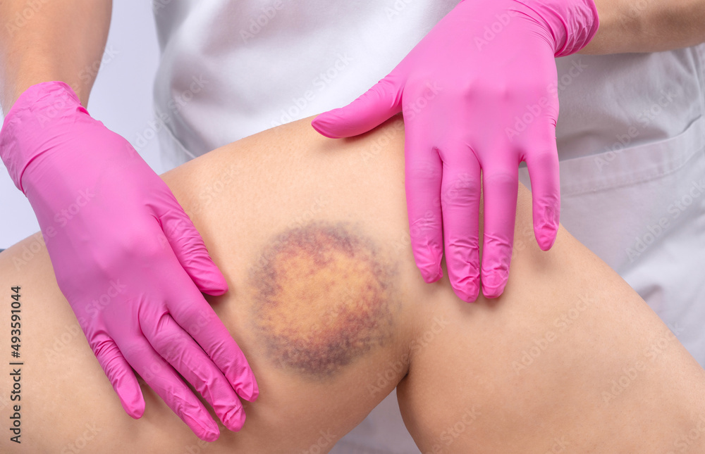 © Dimid - Large bruise on the patient's leg. The doctor examines the leg and smears the ointment.