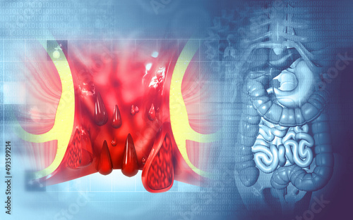 Slika na platnu Haemorrhoids (piles) on scientific background