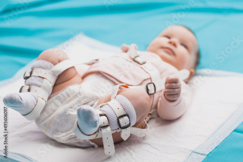 A baby wearing a harness that corrects hip dysplasia photo