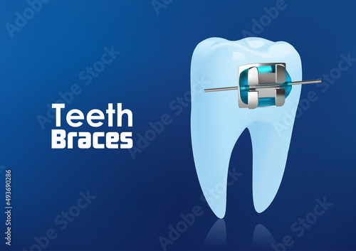 Orthodontic teeth or dental braces concept . illustration vector