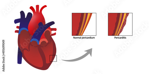 Pericarditis. Normal and infected pericardium illustration in a heart anatomy. photo