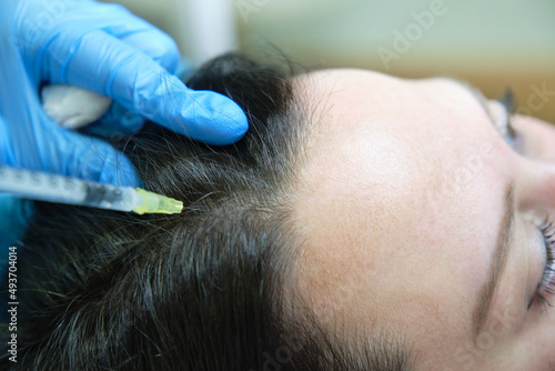 application of capillary mesotherapy for hair loss photo