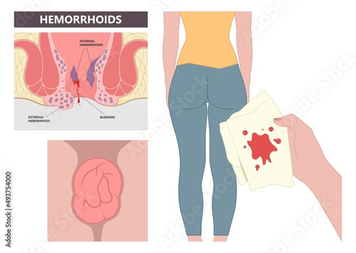 Piles swollen blood anus treat band surgical home sitz baths colon cancer examine rectum pain ligator clots stapler PPH Laser regular lump Digital anal canal thrombectomy thrombosis fistula removal