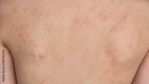 boy back rash skin allergy due to cow protein