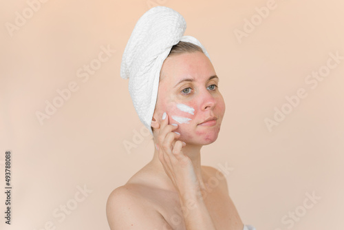Young woman with problem skin with care cream on her face. Girl with acne in bath towel on a beige background.