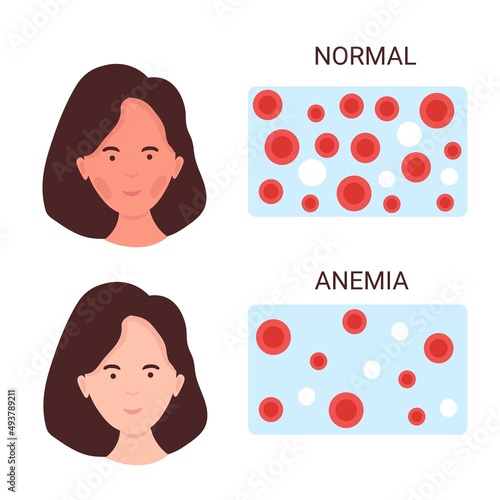 Pale woman suffering from anemia. Vector medical poster with red and white blood cells