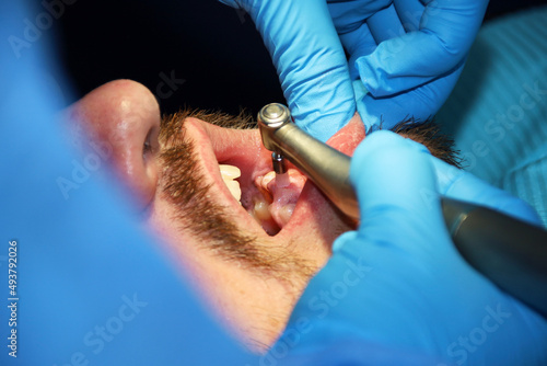 A man with a slight beard undergoing a dental procedure