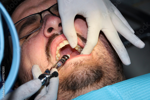 A man with a slight beard undergoing a dental procedure