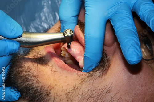 A man with a slight beard undergoing a dental procedure
