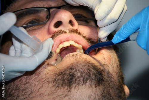 A man with a slight beard undergoing a dental procedure
