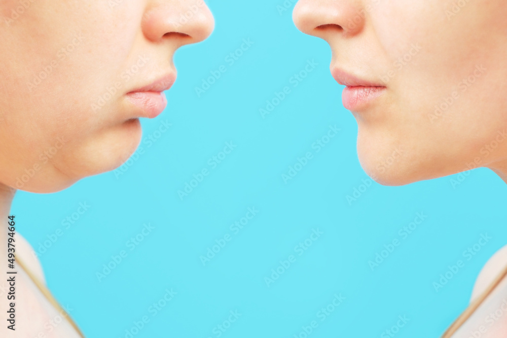 Obraz premium Profile of female face with and without a second chin, concept before and after plastic surgery.